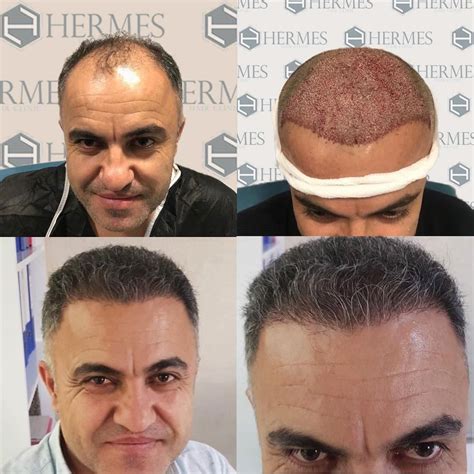 hermes hair clinic saç ekimi merkezi|hermes hair transplant istanbul.